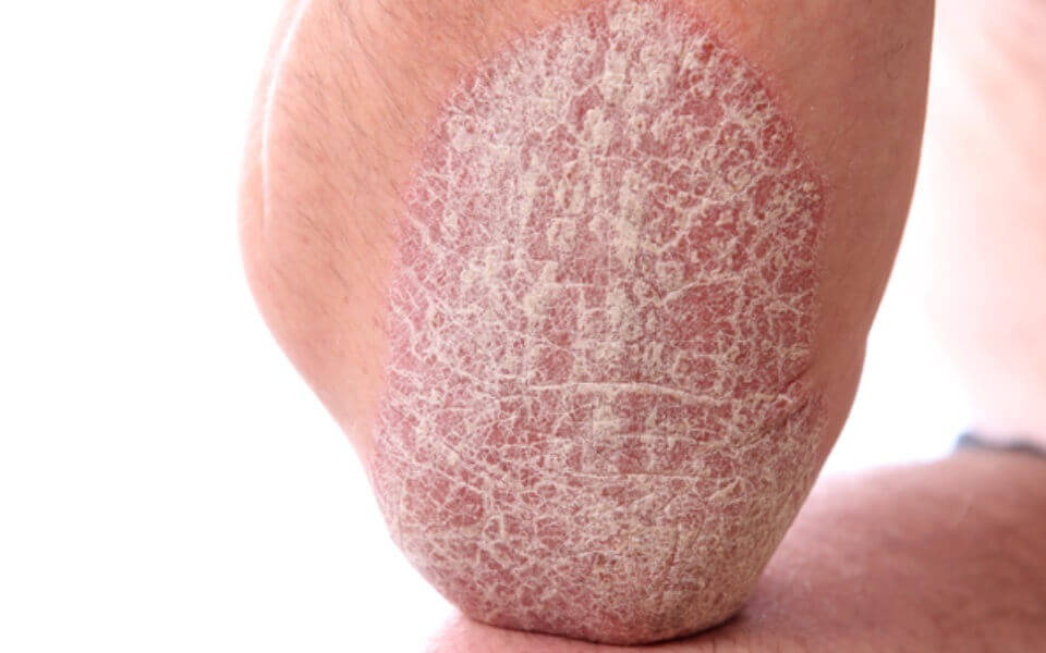Psoriasis Ursachen F r Schuppenflechte Und Behandlungsm glichkeiten 